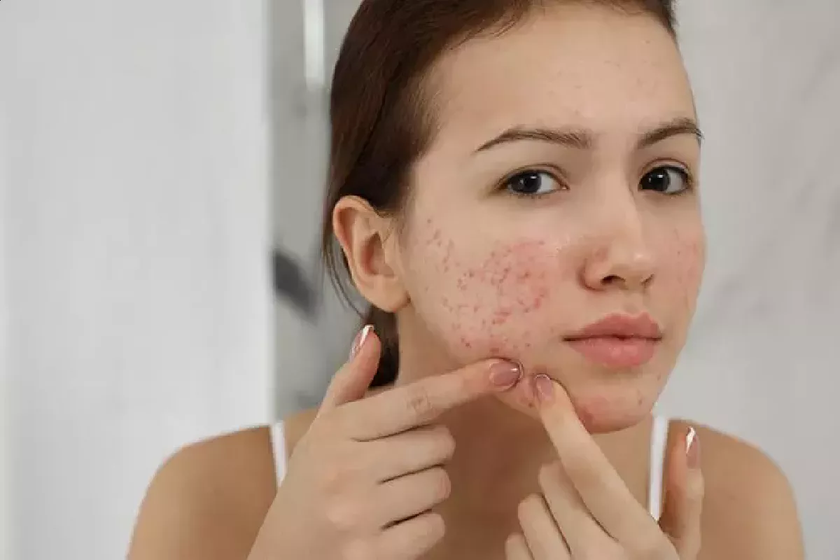 Skin and Acne Inflamation