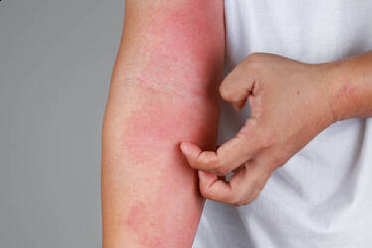 Skin Allergies