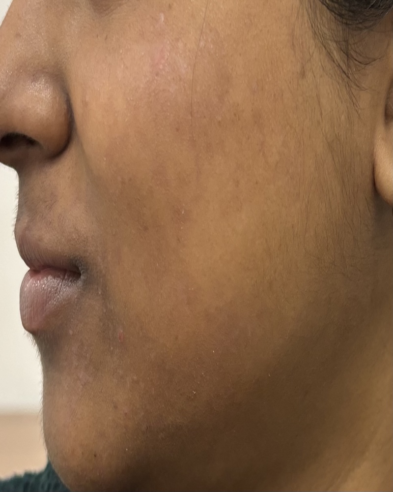 Before Acne Scar Revision