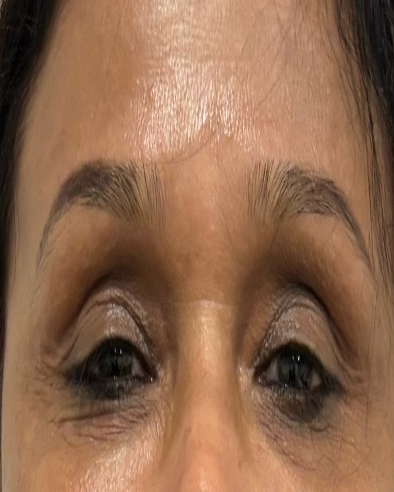 Before Melasma Treatment