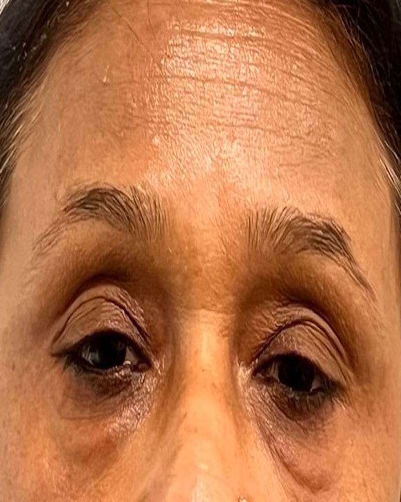 Before Melasma Treatment